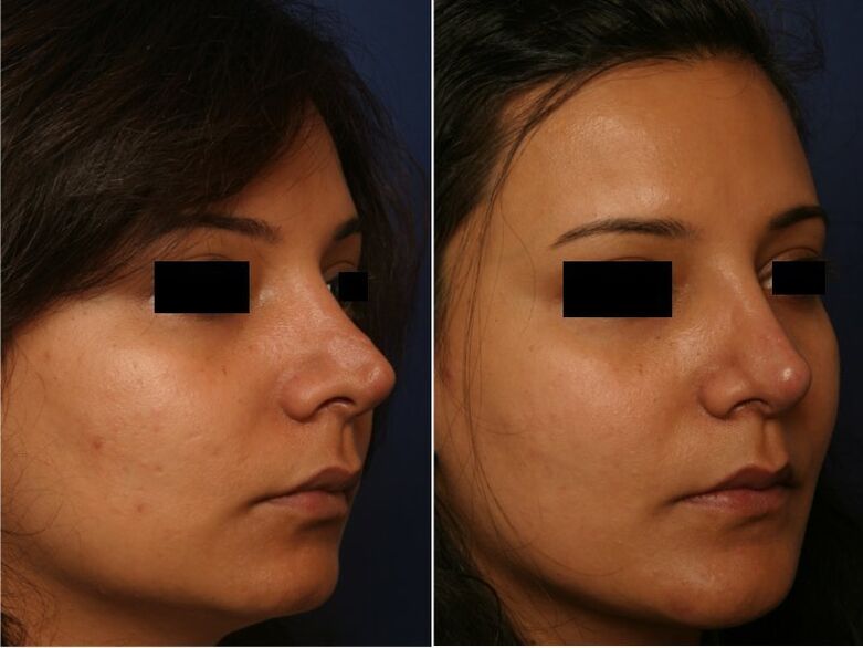 Risultato della chirurgia plastica