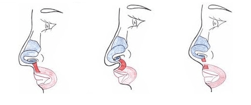 Accorciamento di parte del muscolo nasale