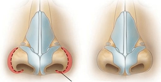 Riduzione delle narici