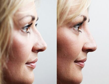 Prima e dopo rinoplastica con filler