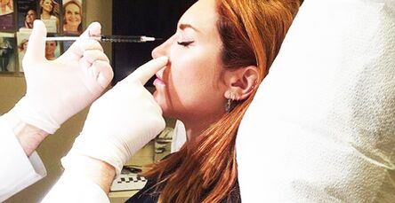 Rinoplastica con filler