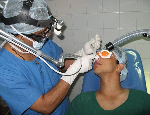 Correzione del setto con bisturi laser