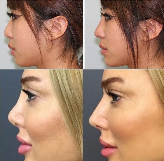 Foto prima e dopo la rinoplastica non chirurgica