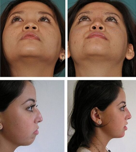 Foto prima e dopo la rinoplastica senza intervento chirurgico