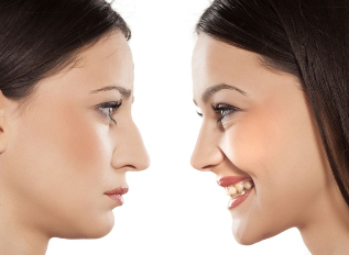 Rinoplastica naso prima e dopo