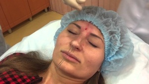 Le suture vengono inseriti sotto la pelle del naso